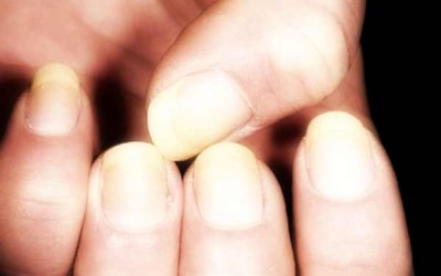 Unghie gialle: i migliori rimedi naturali unghie gialle ingiallite 400x250 1