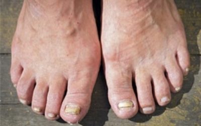 Micosi ai piedi: come prevenirla e rimedi naturali 8